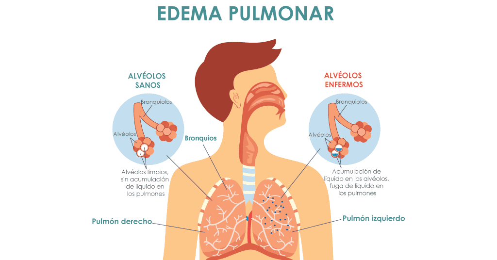 una ilustración que muestra los alvéolos sanos frente a los alvéolos no sanos en pulmones llenos de líquido una ilustración que muestra los alvéolos sanos frente a los alvéolos no sanos en pulmones llenos de líquido